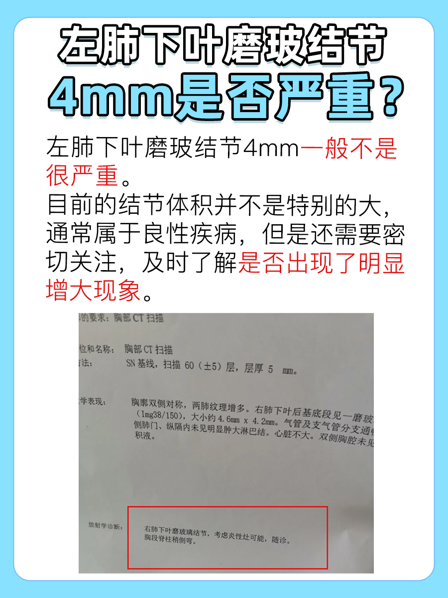 揭秘左肺下叶磨玻结节4mm严重性，速来围观
