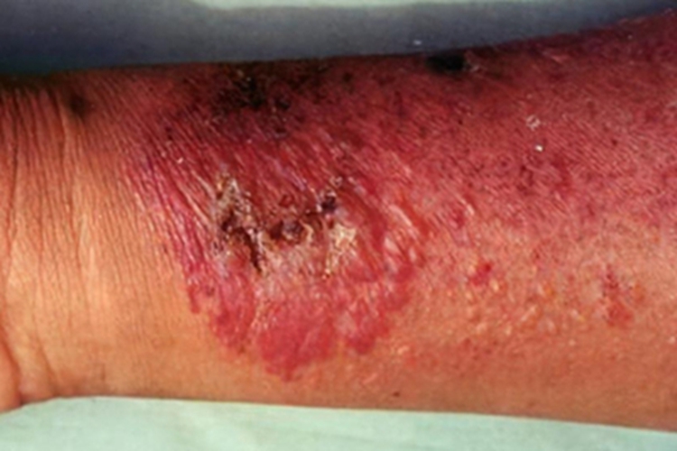 迟发性皮肤卟啉病胳膊症状图 迟发性皮肤卟啉病胳膊症状图