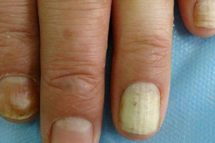 全白甲手指甲症状图