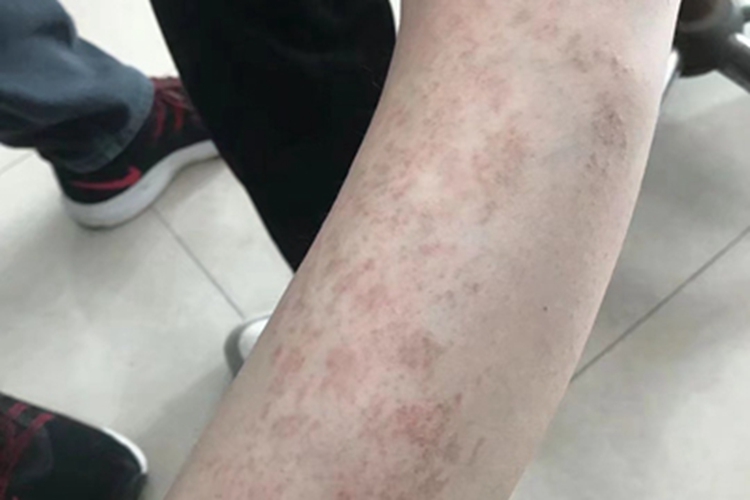 色素性荨麻疹小腿斑块图