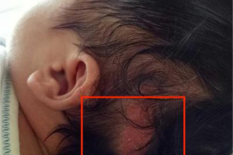 新生儿皮脂腺增生红斑图