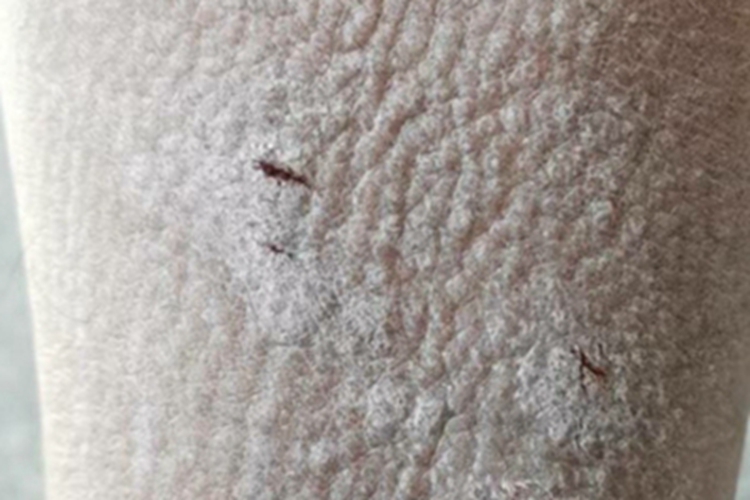 继发性皮肤淀粉样变小腿疙瘩图 继发性皮肤淀粉样变小腿疙瘩图