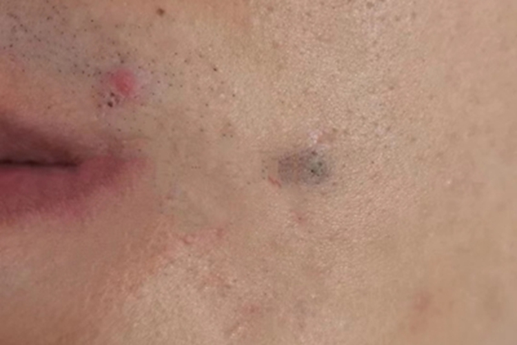 普通蓝痣面部症状图