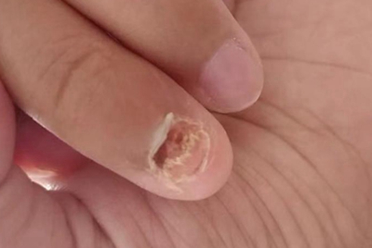 指甲萎缩指甲变薄起皮图