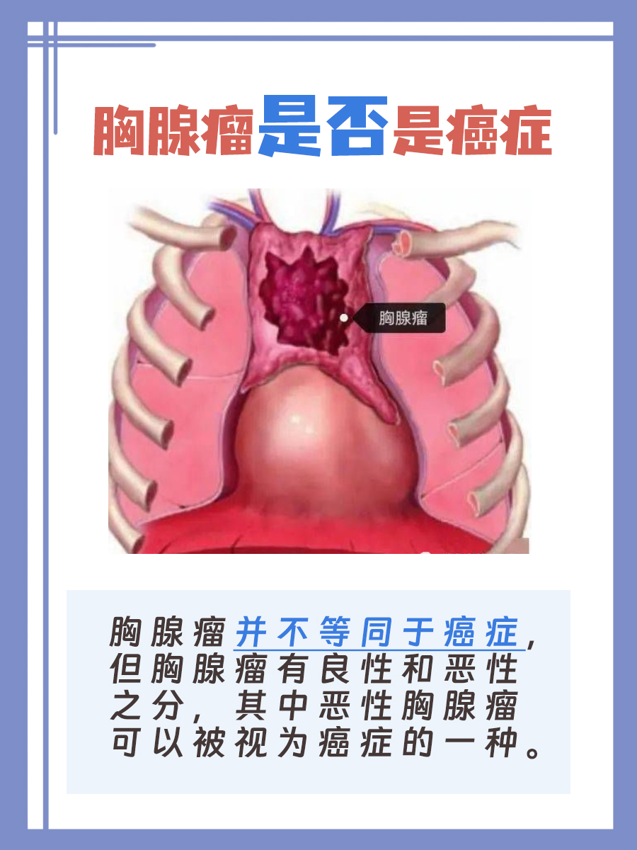 胸腺瘤是癌症吗？你知道吗？