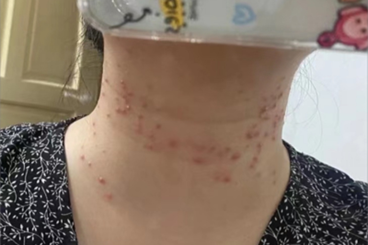 马拉色菌毛囊炎前颈症状图