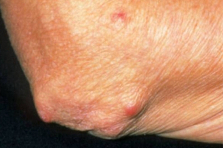 结节病肘部症状图 结节病肘部症状图