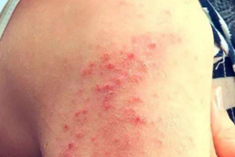 急性湿疹胳膊小疙瘩图