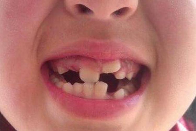 小孩换牙图 小孩换牙图