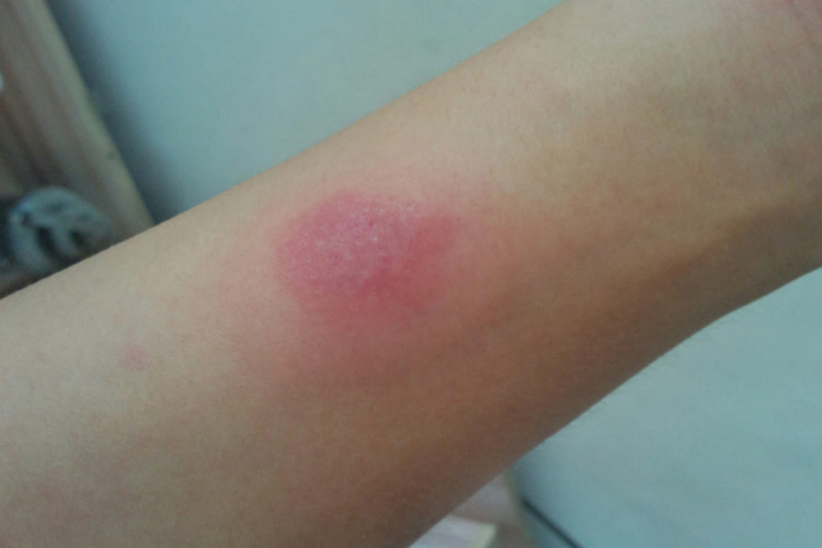 青霉素皮试阳性红晕周围伪足图