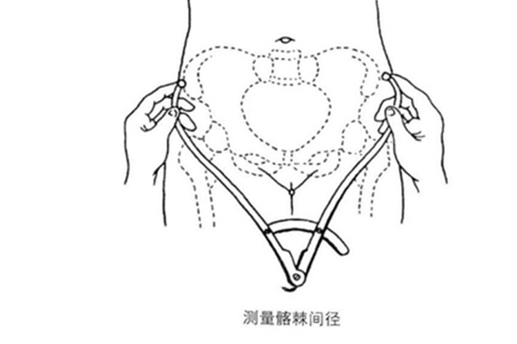 髂棘间径测量图