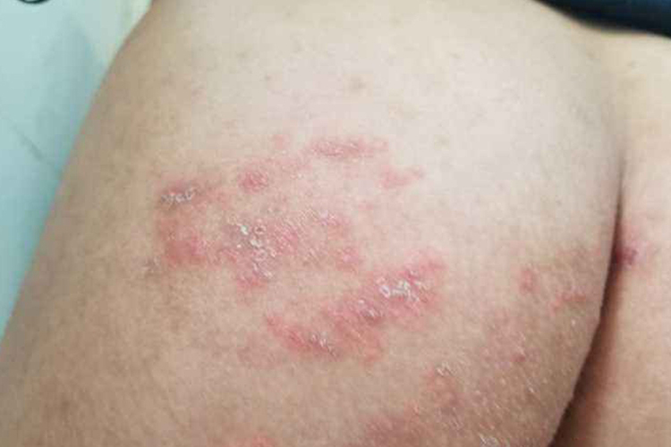 小孩屁股慢性湿疹图