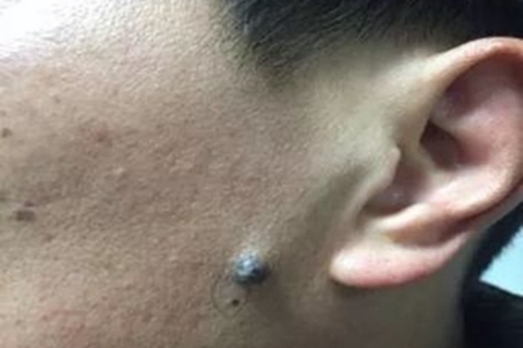 皮内痣面部痣图