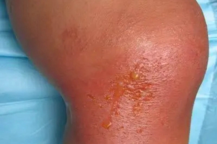 接触性皮炎膝盖症状图 接触性皮炎膝盖症状图