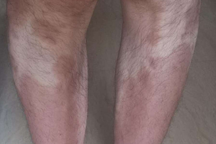 炎症后色素沉着小腿症状图