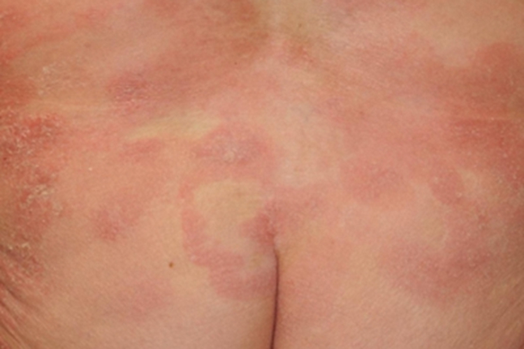 环状肉芽肿臀部红斑图