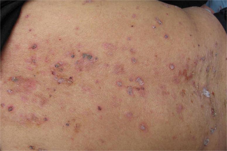 天疱疮背部红斑图