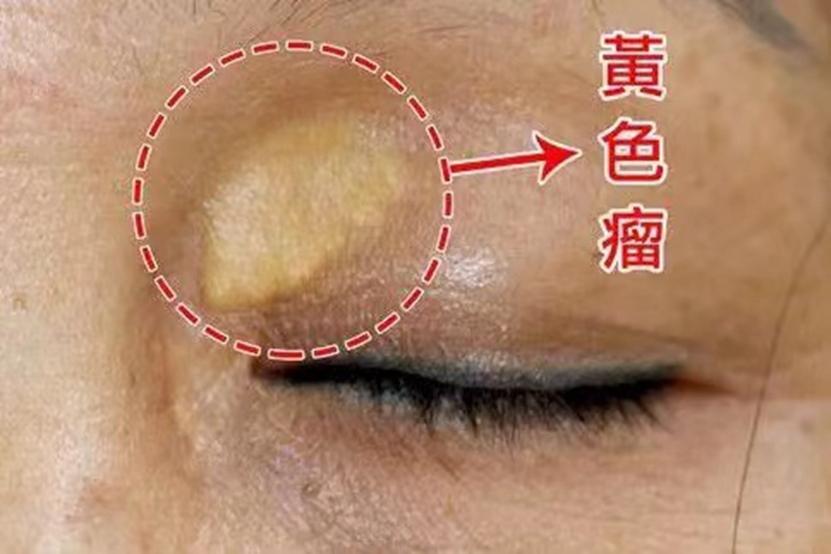 扁平黄瘤图
