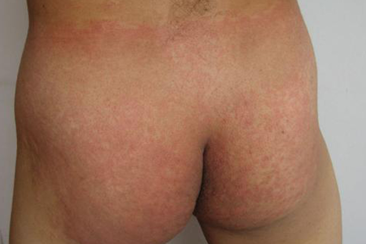 内裤过敏密集丘疹图