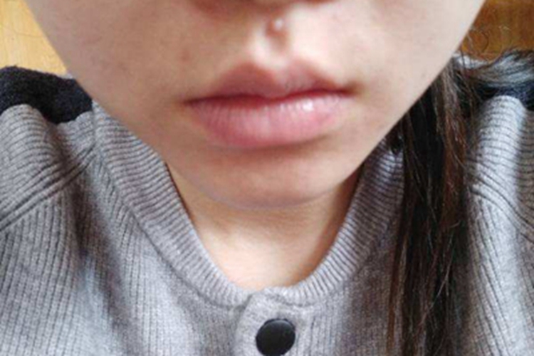 小汗腺汗孔瘤小疙瘩图