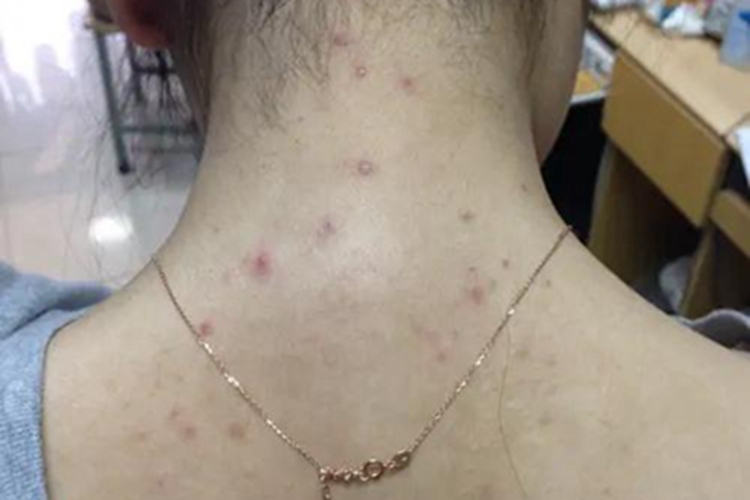 螨虫皮炎后颈症状图