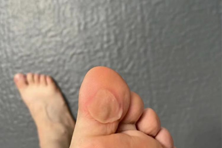 脚趾长水疱脚趾有干瘪水疱图 脚趾长水疱脚趾有干瘪水疱图