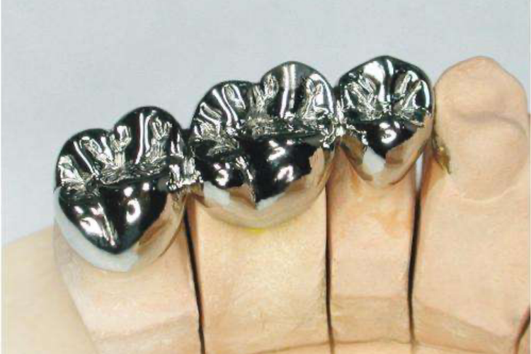 铸造金属全冠图 铸造金属全冠图