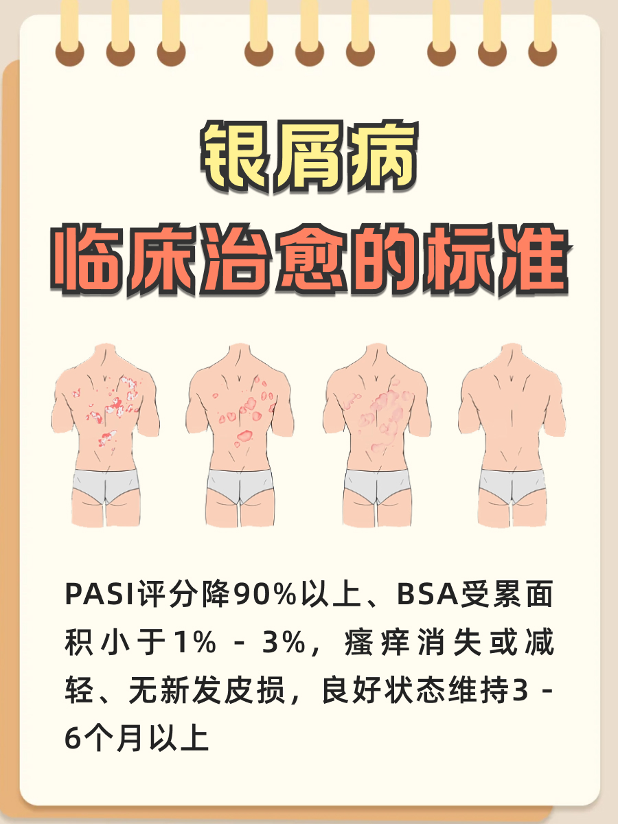 阿普米司特片能治愈银屑病吗？医生来揭秘