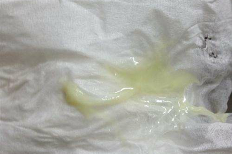 滴虫阴道炎绿色分泌物图