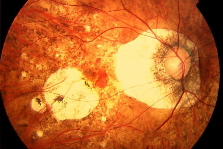 高度近视眼底图 高度近视眼底图