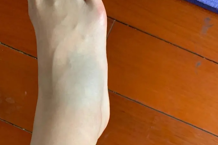 踝关节扭伤肿胀图