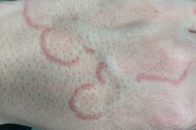 离心性环状红斑图