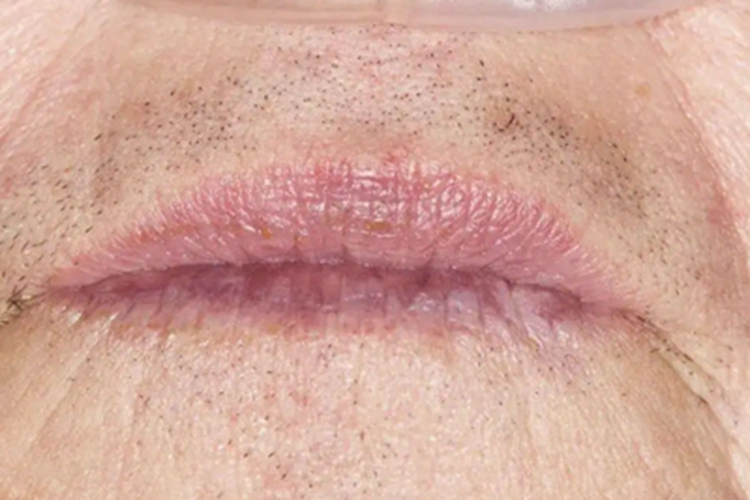 光老化嘴唇臭味有皱纹图 光老化嘴唇臭味有皱纹图