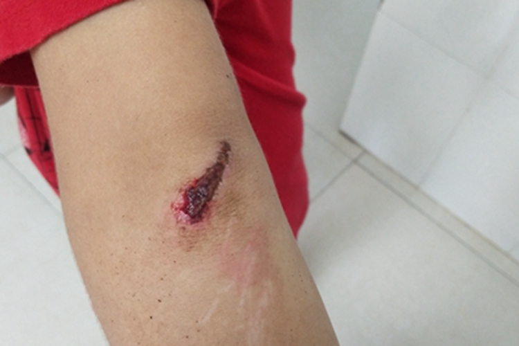 跌伤肘部结痂图