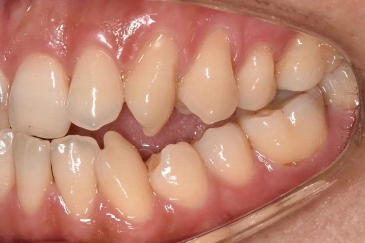 牙齿对刃图 牙齿对刃图