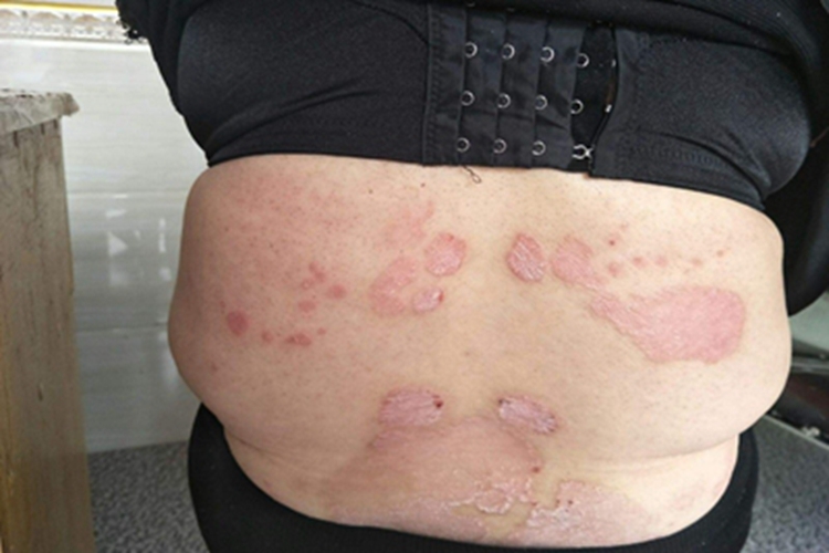 寻常狼疮背部发红图