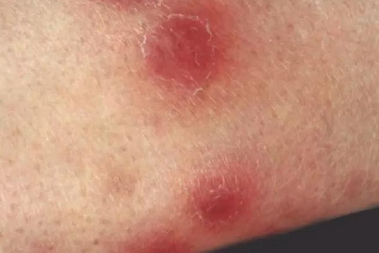 黑色的虫子咬人很疼会肿图