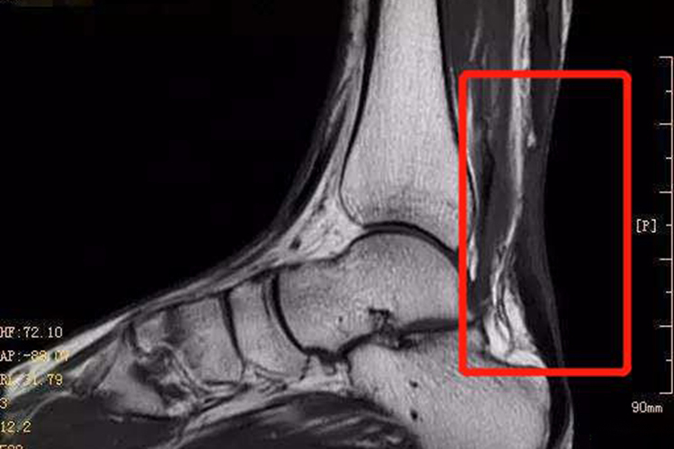 跟腱断裂位置图 跟腱断裂位置图
