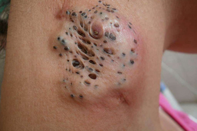 黑头粉刺样痣硬块图