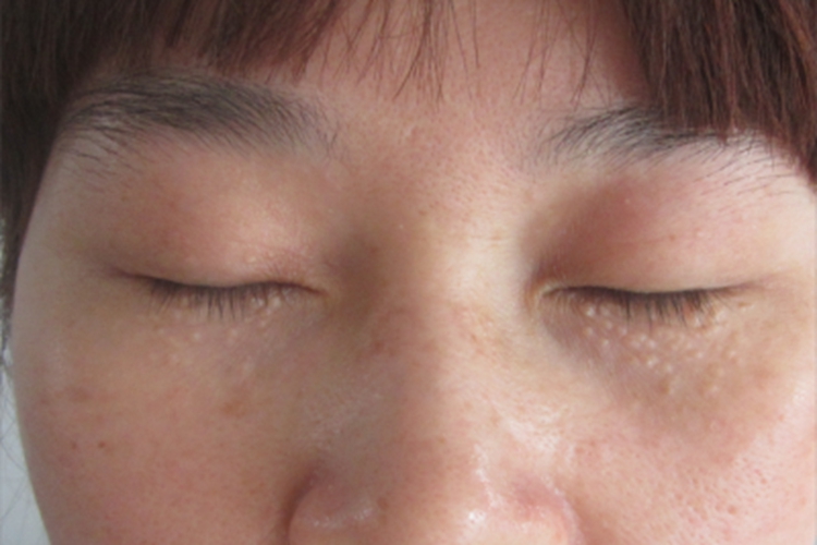 汗腺瘤下眼睑小米大小丘疹图