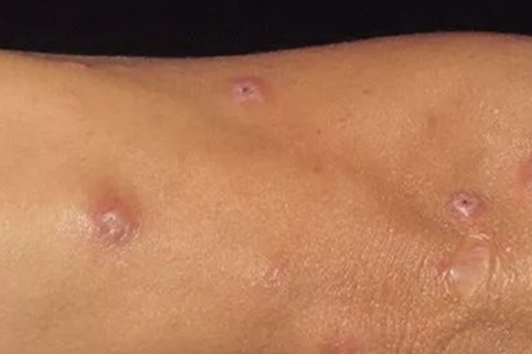 瘤型麻风结痂图 瘤型麻风结痂图