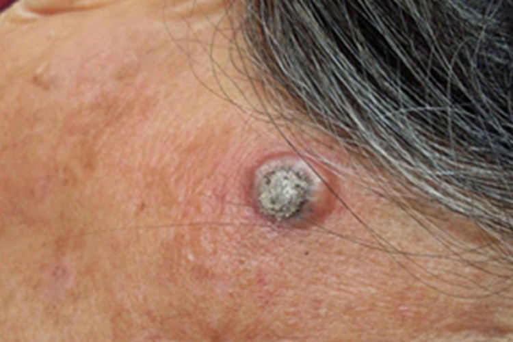 单发型角化棘皮瘤疙瘩图