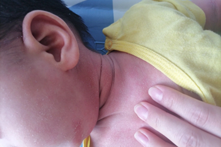 婴儿期特应性皮炎颈部脱皮图 婴儿期特应性皮炎颈部脱皮图