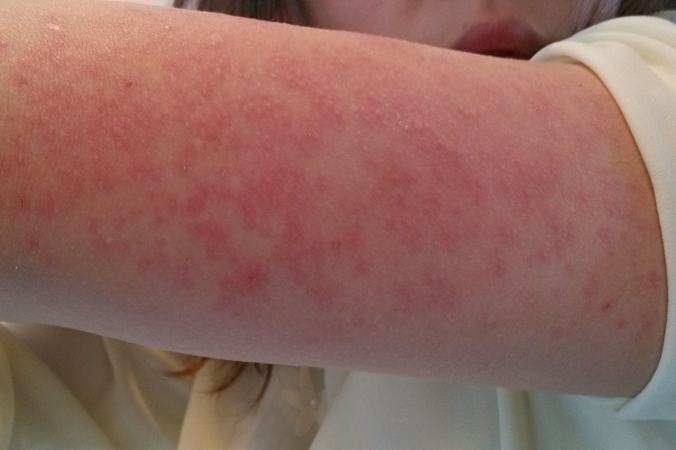 麻疹胳膊丘疹图