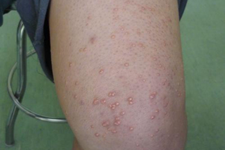 结节性黄瘤大腿小疙瘩图