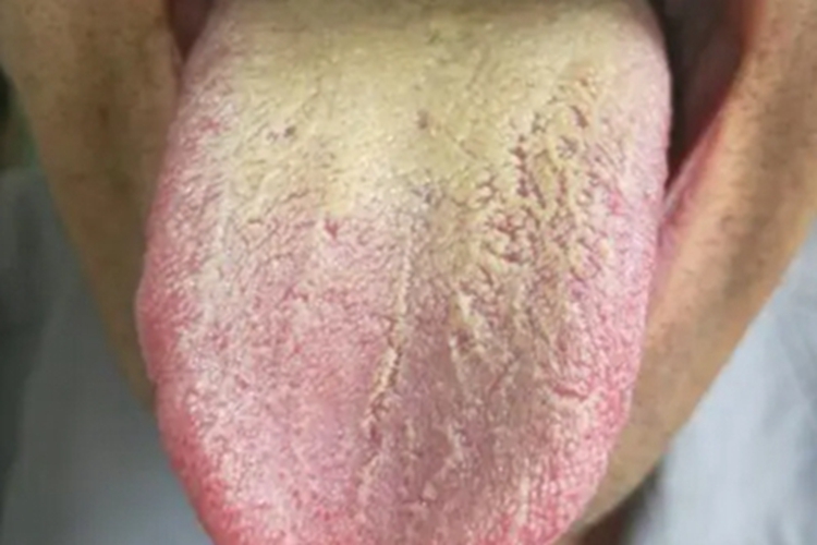 毛舌舌头后半截发黄图