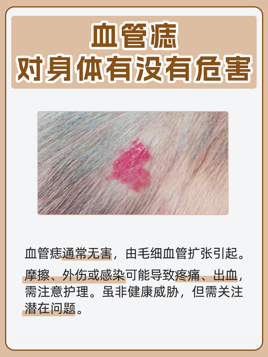 血管痣：对身体是否有潜在危害？