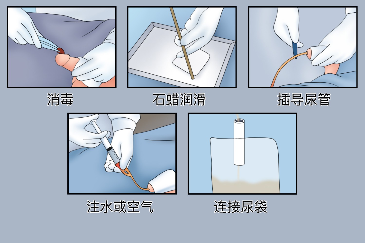 三腔导尿管使用方法图 三腔导尿管使用方法图