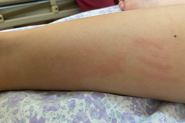 宝宝皮肤划痕症条形风团图