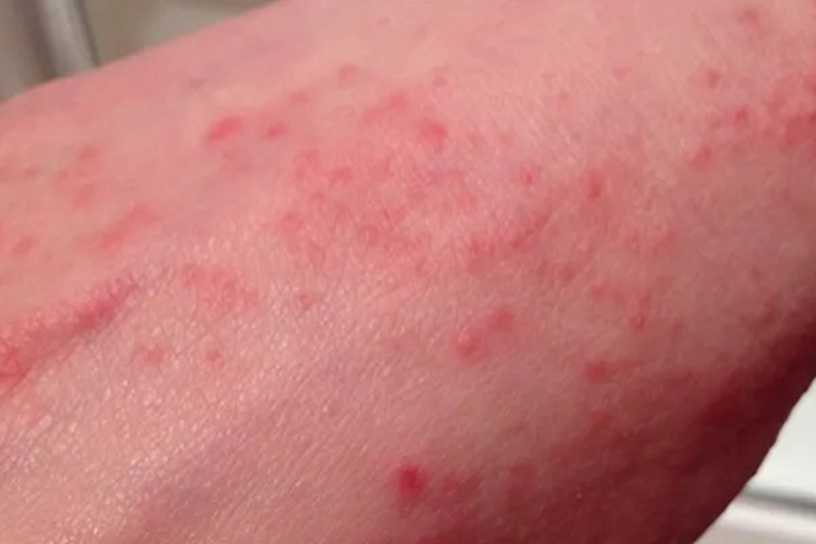 白血病非特异性皮损图